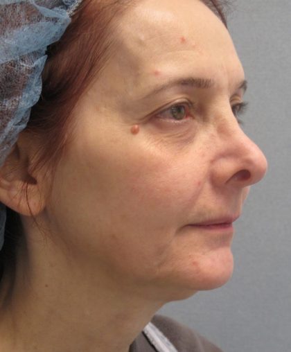Fractional CO2 Laser Before & After Patient #2647