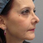 Fractional CO2 Laser Before & After Patient #2647