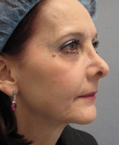 Fractional CO2 Laser Before & After Patient #2647