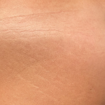 Morpheus8 Before & After Patient #2673