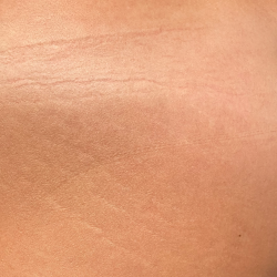 Morpheus8 Before & After Patient #2673