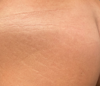 Morpheus8 Before & After Patient #2673