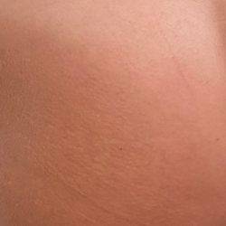 Morpheus8 Before & After Patient #2673