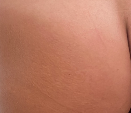 Morpheus8 Before & After Patient #2673
